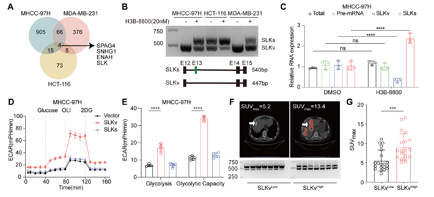 The SLK exon 13 skipping variant SLKv is significantly associated with enhanced glycolysis and promotes tumor progression