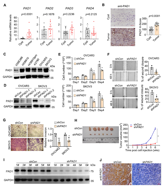 PAD1 expression is positively correlated with OC progression